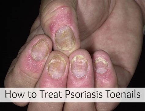 How To Treat Psoriasis Toenails Nail Psoriasis Treatment Nail