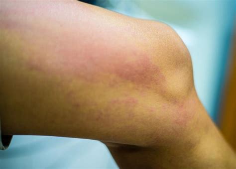 Can A Food Allergy Cause Rashes On Your Buttocks And Inner Thighs