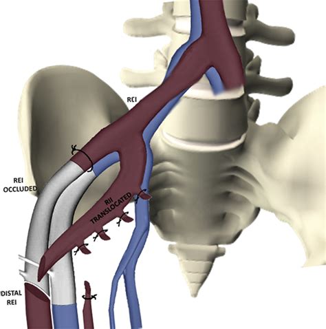An Original External Iliac Artery Reconstruction With Internal Iliac