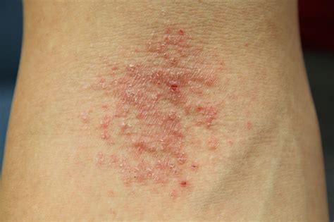 Reshapelife Eczema The Itch That Keeps On Itching
