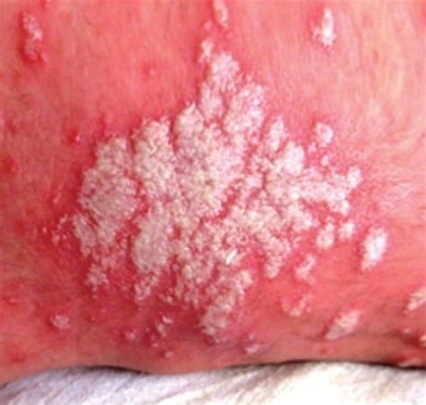 Cutaneous Candidiasis As Related To Dermatitis Pictures