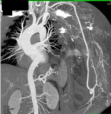 Occlusion Left Brachial Artery With Bypass From Left Subclavian To