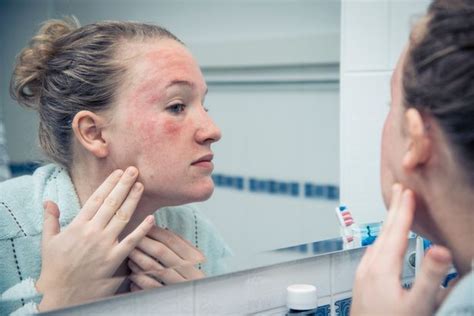 Easy To Find Vitamin Supplement Shown To Improve Symptoms Of Eczema