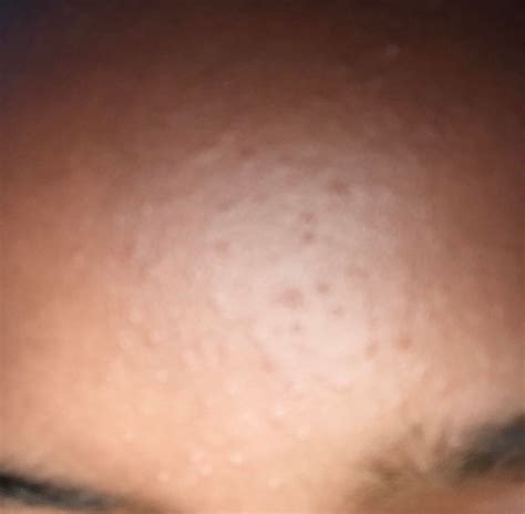 Skin Concerns Skin Colored Bumps All Over Forehead And Nose Details