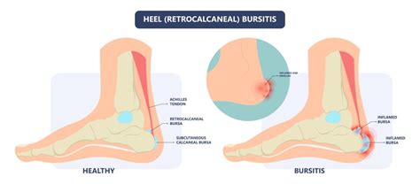 Bursitis Ankle Causes Best Treatment Options In 2024