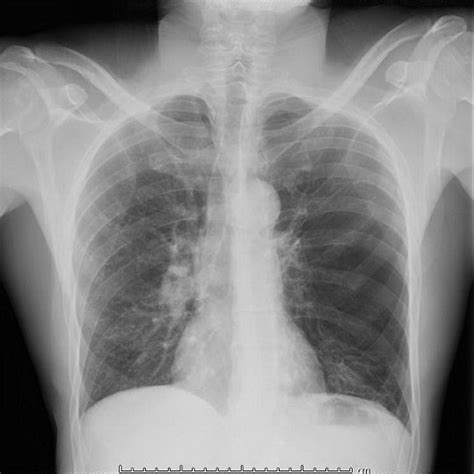 Pdf A Unilateral Hyperlucent Lung Swyer James Syndrome A Case