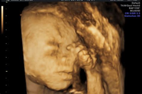 Ultraschall Ultraschallbilder Aus Dem 3 Trimester Elternde