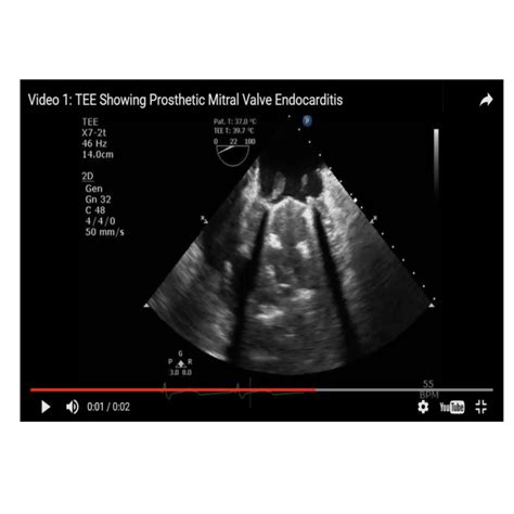 Pdf Prosthetic Mitral Valve Endocarditis Presenting As Complete Heart