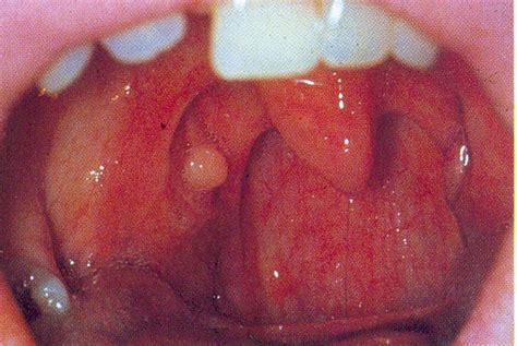 Tonsil Cyst Symptoms Causes Treatment Pictures And More