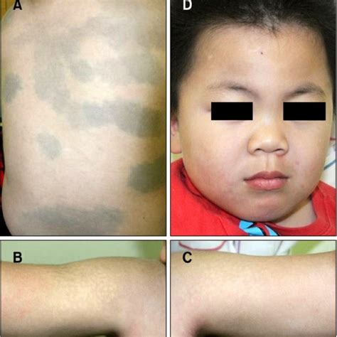 A Extensive Round And Oval Patches Of Blue Gray Hyperpigmentation On