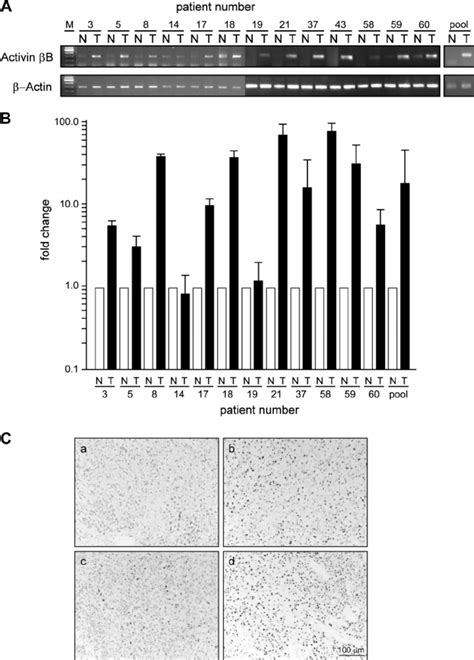 Activin B Expression Is Upregulated In Clear Cell Rcc Compared To