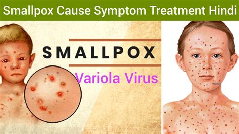 Smallpox Variola Cause Symptoms Diagnosis Treatment In Hindi