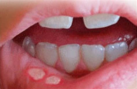 Research Dispels Myths About Recurrent Aphthous Stomatitis Dentistry Today