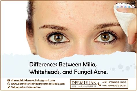 Differences Between Milia Whiteheads And Fungal Acnediwali Offer