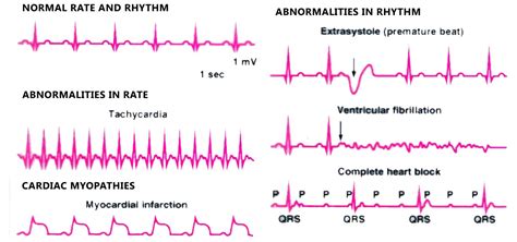 Common Examples Of Abnormal Ecgs 11 A Normal Sinus Rh