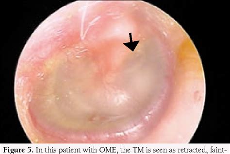 Figure 5 From The Otoscope A View Through Distinguishing Acute Otitis