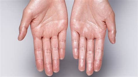 What Is Hyperhidrosis D Lux Medspa