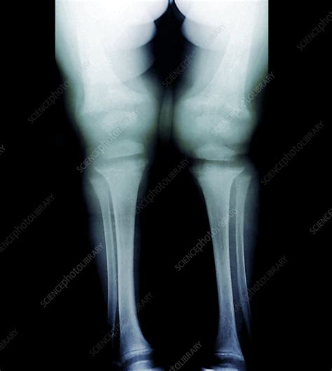 Childhood Rickets X Ray Stock Image C0104881 Science Photo Library