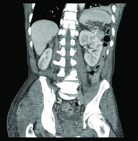 Coronal View Computed Tomography Ct Abdomen And Pelvis With Contrast