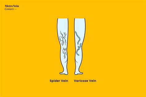 Spider And Varicose Vein Removal Treatment Metro Vein Centers