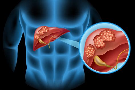 Cancer Du Foie Quels Sont Les Symptômes Et Peut On Le Soigner