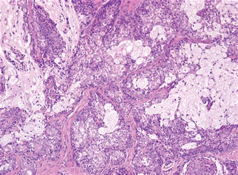 Mucoepidermoid Carcinoma Of The Parotid Gland Head And Neck Cancer