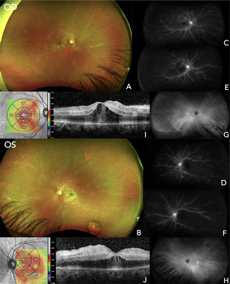 Multimodal Imaging In Case 1 A And B Optos Ultra Widefield Uwf