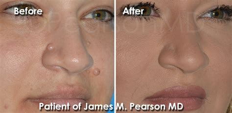 Mole Removal Photos Before And After Dr James Pearson Facial Plastic