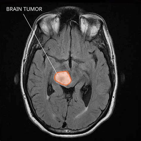 Only when a tumor is large enough to press. Diffuse Midline Gliomas - National Cancer Institute