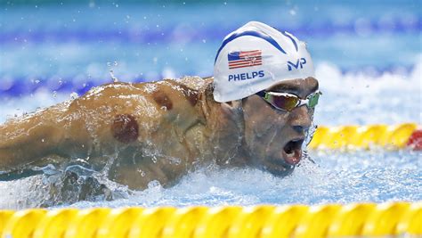 Michael Phelps Cupping Therapy 5 Fast Facts You Need To Know
