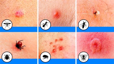 Bed Bug Bites How To Tell If You Have Them