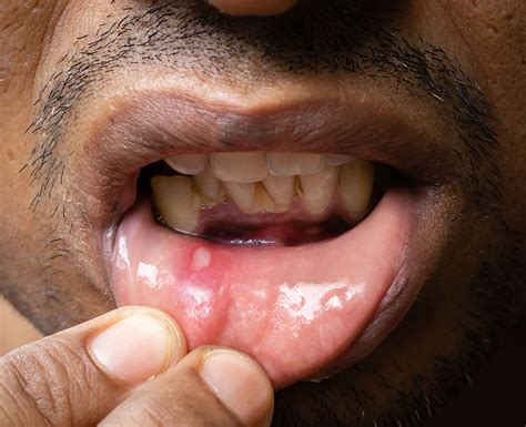 Mouth Ulcers Types Causes Treatment