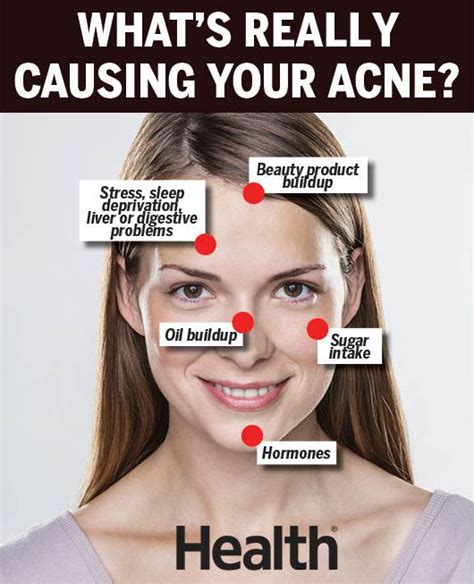 Acne Face Mapping Can Reveal The True Cause Of Your Breakouts 2023