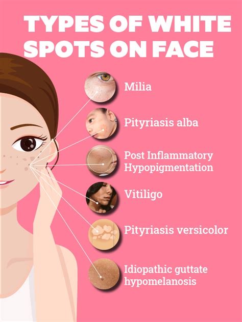 Everything You Need To Know About White Spots On Face Be Beautiful