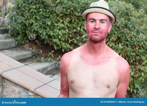 Man With Pale Complexion Getting Sunburnt Stock Image Image Of Body