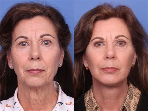 Facelift Before And After Pictures Case 80 Scottsdale Az Hobgood Facial Plastic Surgery