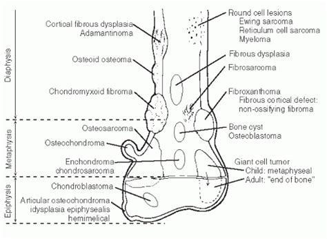 Bone Tumors Of The Foot And Ankle Musculoskeletal Key