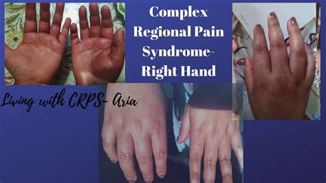 Complex Regional Pain Syndrome Crps Flare Ups Youtube