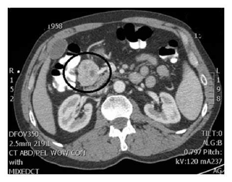 Ct Scan Of Abdomen And Pelvis With Contrast In A Axial View And B