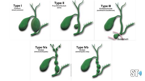 Dms Gallbladder Biliary Tree Pathologies Sonographic Findings Sexiz Pix