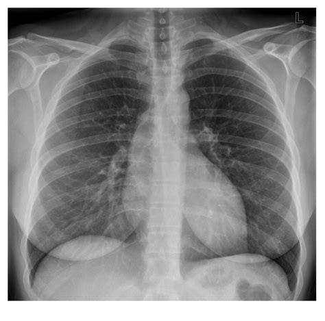 Physical examination revealed orthopnea, cyanosis, apical impulse located on the right side of his chest, and hepatic dullness located in the left subcostal region. Chest x-ray | Emergucate