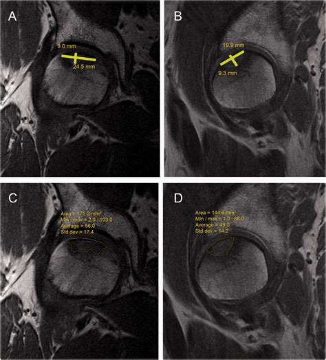 Magnetic Resonance Imaging Of Avascular Necrosis Of The Femoral Head