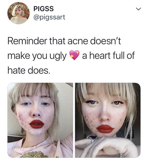 Acne Doesnt Make You Ugly