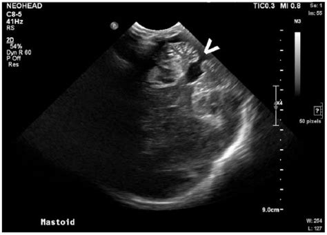 Dandy Walker Malformation With Concomitant Agenesis Of The Corpus
