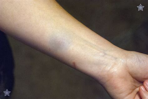 Bruised Arm Flickr Photo Sharing