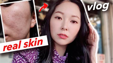 Revealing My Horrible Acne Scars Visited Top Korean Skin Care Clinic