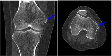 Arthroscopic Management Of Calcific Tendonitis Of The Medial Collateral