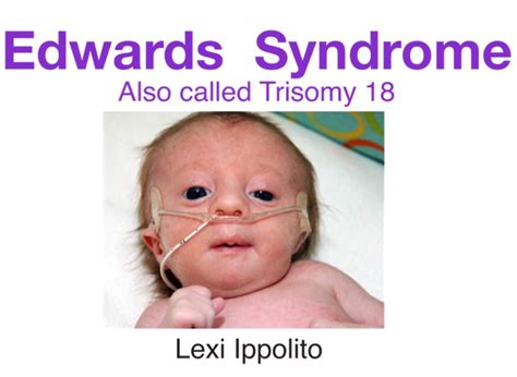Edwards Syndrome Also Called Trisomy 18 Overview Symptoms Treatments