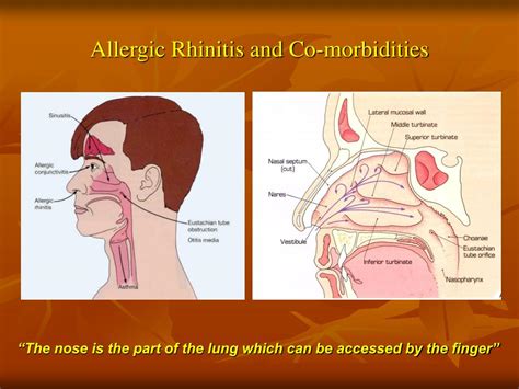 Ppt Allergic Rhinitis And Co Morbidities In Children Powerpoint