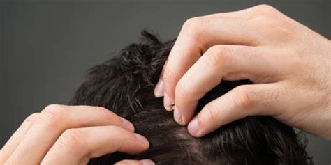 Hair Pulling Disorder Trichotillomania Explained Business Insider